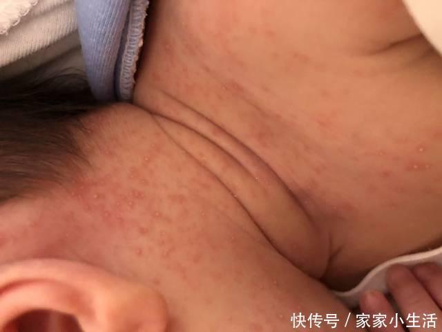 皮肤瘙痒|【家家母婴】宝宝长痱子怎么办?试试这几招!