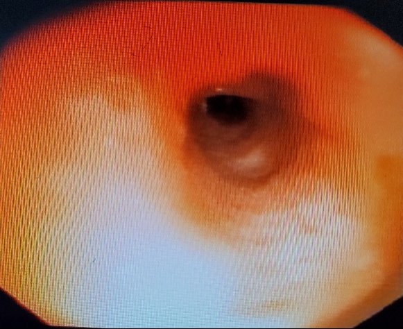 蓝军|都是辣椒尖惹的祸!中国科学院大学重庆仁济医院呼吸与危重症医学科顺利完成支气管异物取出术