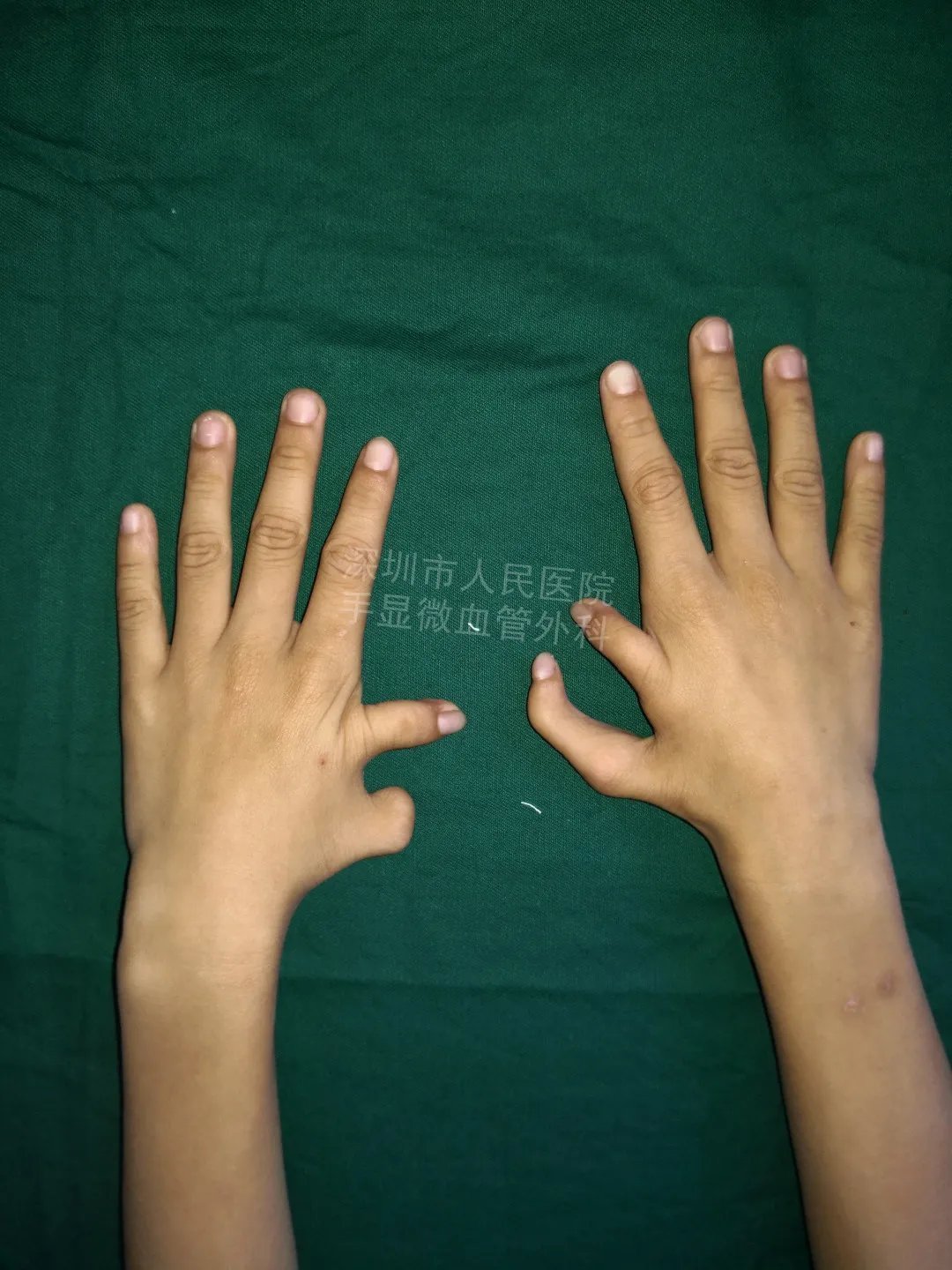 发育不良|得了这病,12岁男孩手指比香蕉还粗!7种常见的手部畸形,家长们要注意