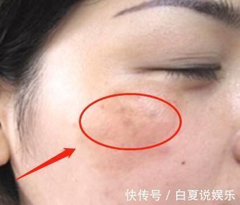 黄褐斑|子宫不好的女人,脸上会有4个“呼救”,要留意