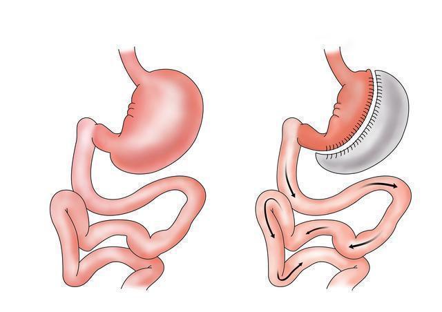 胃病|胃不好百病生，家中1物常泡水，幽门螺杆菌一扫光，胃病自破
