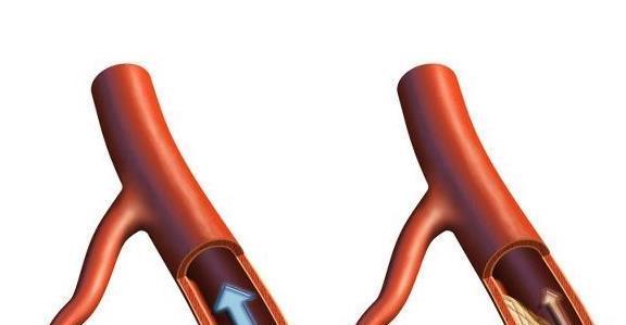 脑中风|血脂高对身体危害大,许多人体检才知道,你知道血脂高的征兆吗?