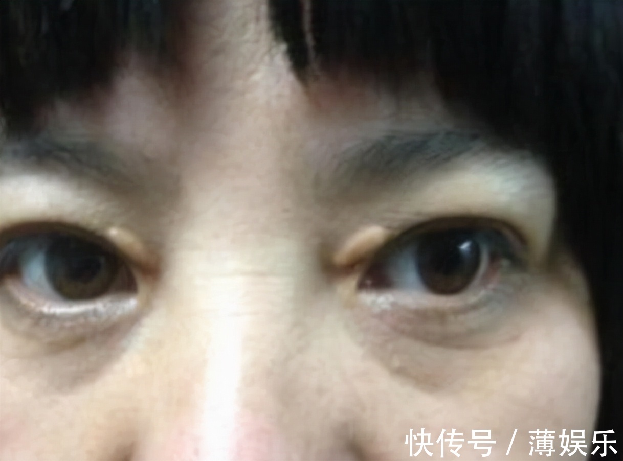 油脂|多走路能降血脂医生提醒日常多吃这4物,或比走路效果好