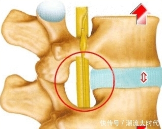 专家：腰椎间盘突出症的预防，以及外出注意事项，转发给需要的人