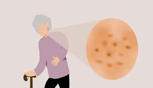 骨头|人老后,为什么驼背、长白发、有老人斑?原因清楚了