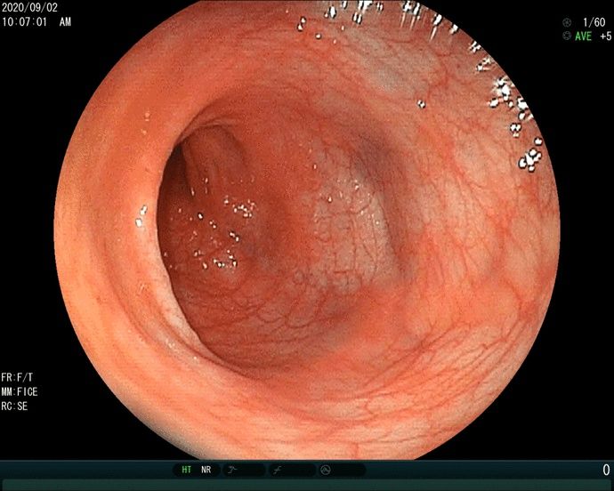 腹泻|从无锡治到上海，这个宝宝的“急性肠炎”不一般