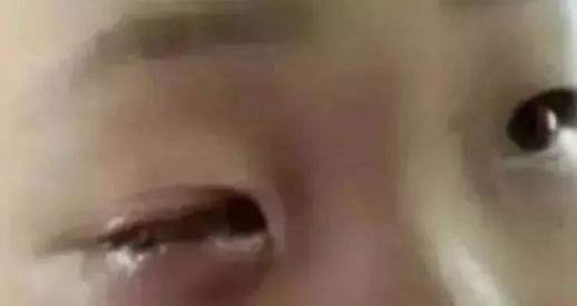 氢氧化钙|4岁男孩眼睛被烧伤，罪魁祸首又是它