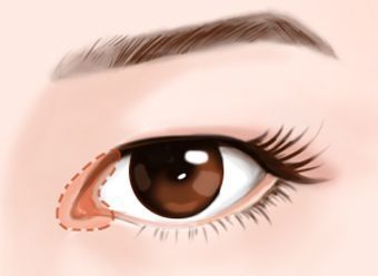 明明只是想割个双眼皮,医生为啥还要我开眼角?难道是为了忽悠我的钱?