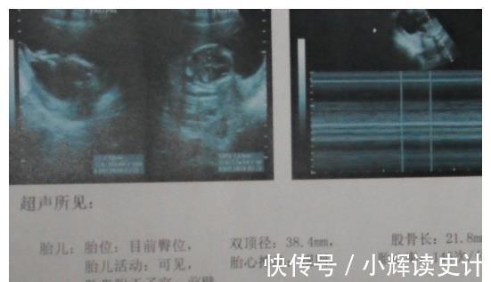 男宝|孕妈孕检时,若怀的是男宝,多数会有这种孕检结果,快来自测一下