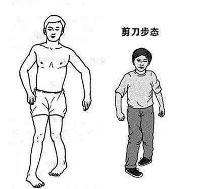 痉挛性脑瘫|小儿脑瘫影响的是整个家庭，父母要及时预防