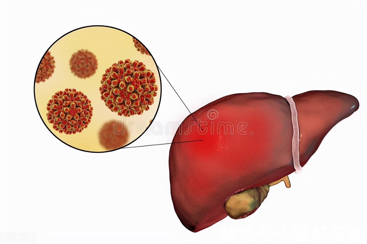 丁型肝炎|肝炎危害大，该如何进行预防？医生建议：做好这5点或能预防肝癌