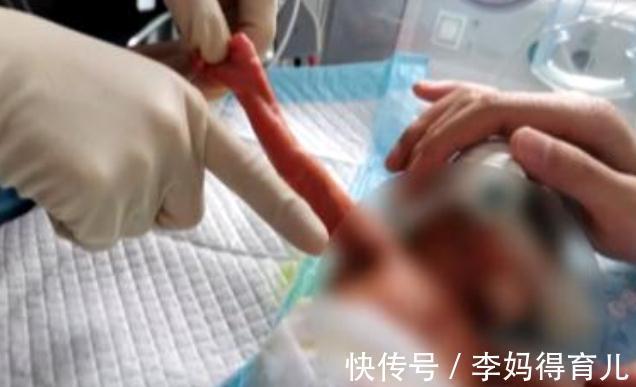 早产|一女婴早产体重仅560克,和成人巴掌差不多大,后奇迹存活