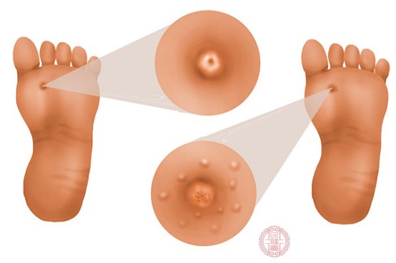 脚趾头上长了个茧一样的硬硬的是怎么回事