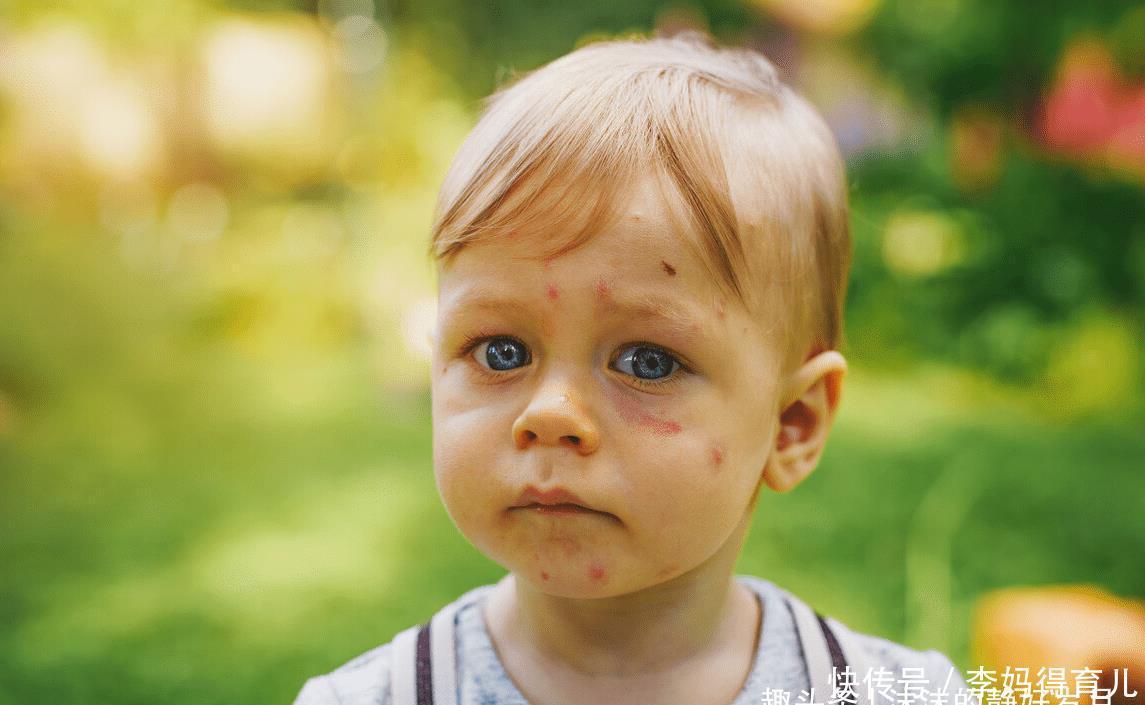 蚊子|嗡嗡嗡,你听你听,蚊子在狰狞的笑,它最喜欢小宝宝