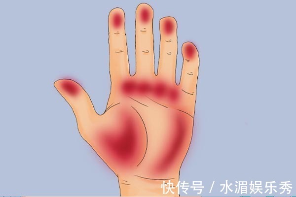 发红|肝硬化先上手脚,手脚的哪些变化,暗示了肝硬化可能找上门了?
