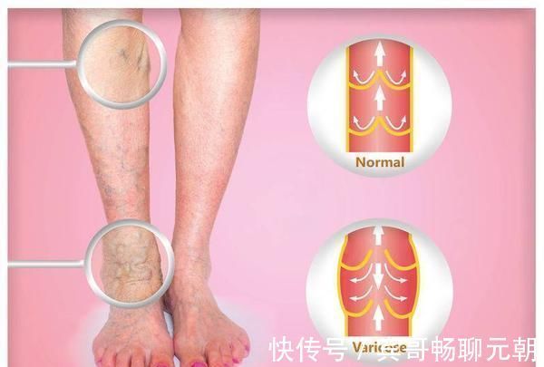 症状|体内有血栓,腿知道!腿部有3个症状,说明血栓已形成,及时揪出
