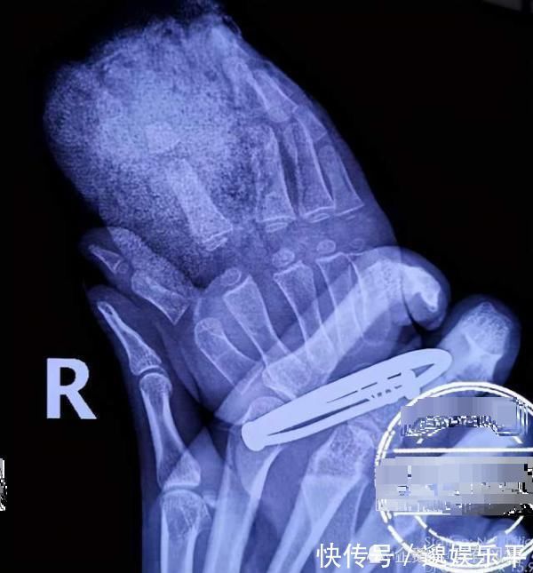 女童|2岁女童活泼好动,手指当场被切断! 父母就在一旁