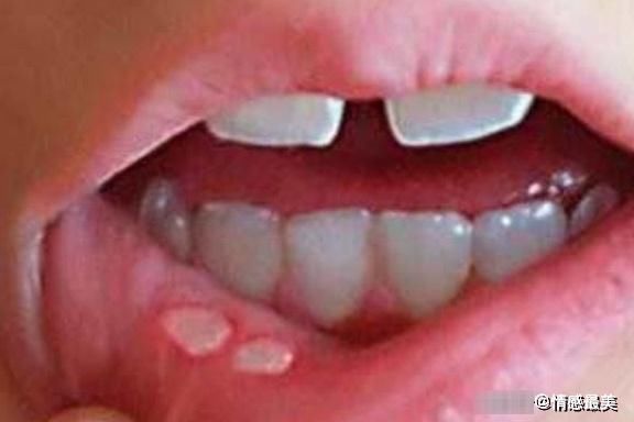 缺锌|宝宝若有4种表现,多半是缺锌了,要及时,影响发育