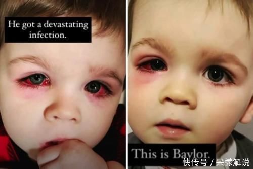 母亲|外国小孩儿洗澡后双眼通红,原来是粗心母亲忘了小心“小黄鸭”