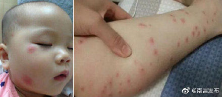 南昌|紧急提醒 ！南昌疾控：注意预防蠓虫叮咬！