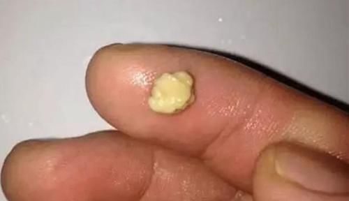 口臭|孩子被嘲笑“嘴臭”,遭同学孤立,医生取出的东西宝妈也说臭