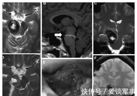 婴孩|孕妈瘫痪,竟是脑干肿瘤出血作祟,脑干手术后诞下婴孩造医学奇迹