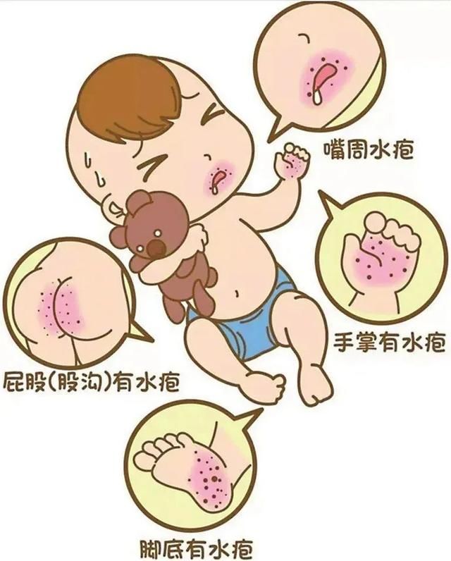 防护|手足口病高发期！做好这些事情，让孩子的防护力加倍