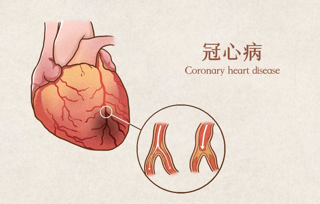 后移|发际线后移或是冠心病征兆？做好这几件事就不怕！