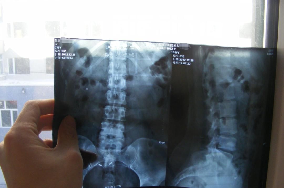 手术治疗|腰椎间盘突出真实经历过程，腰椎间盘突出症原来可以这么做