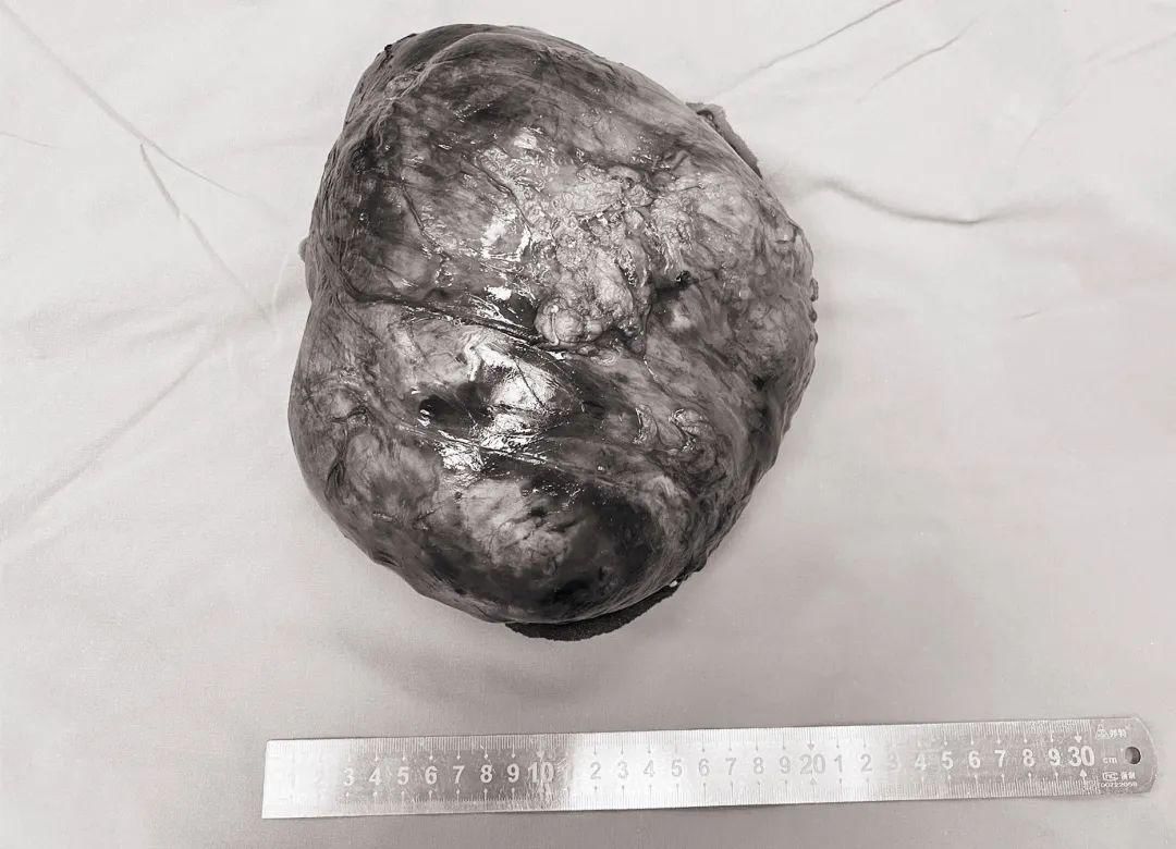 五旬女子“怀胎”10年“生下”西瓜大肿瘤,不换血管摘瘤省了五六万