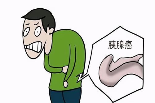 胰腺癌|胰腺癌生存率低,不易被发现,提醒:早期的3个症状,你没当回事