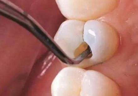 牙缝里“臭烘烘”的东西是啥?多半是此物在“捣鬼”,别忽视了