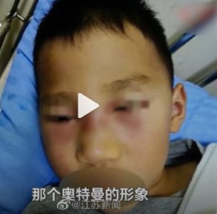 细菌感染|长沙5岁男孩经常挖鼻孔导致细菌感染，面部红肿似“奥特曼”
