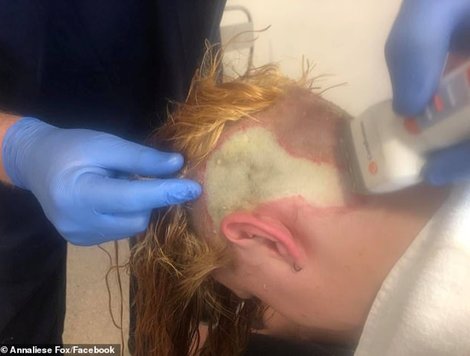 澳洲女孩自己动手漂头发被严重烧伤需植皮 快资讯