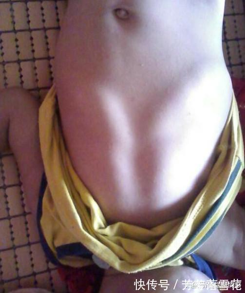 维d|“鸡胸”宝宝越来越多, 到底该怎么做才能预防这种情况的发生