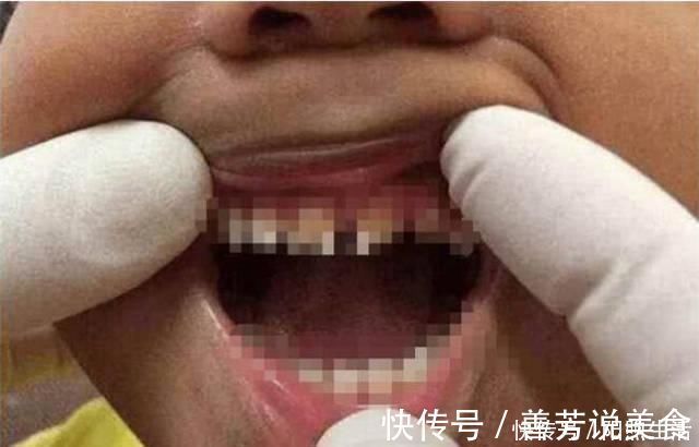 生活质量|5岁男孩的牙齿全部烂掉,医生训斥无知,妈妈没想到这么严重