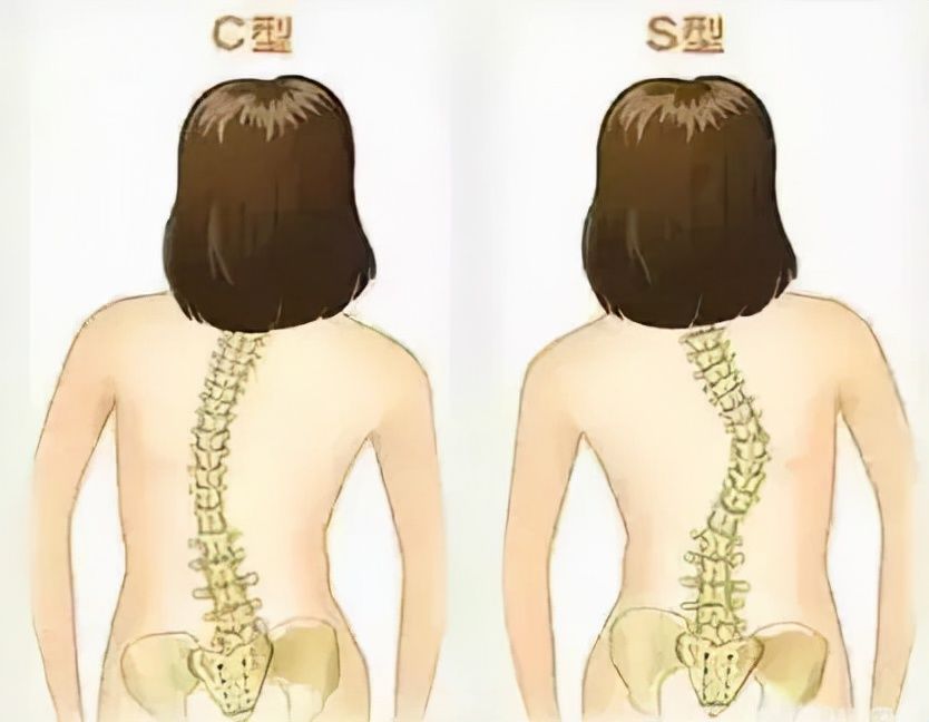 脊柱|8岁男孩脊椎侧弯，只因家人常这样做，这个错误，90%的父母都在犯