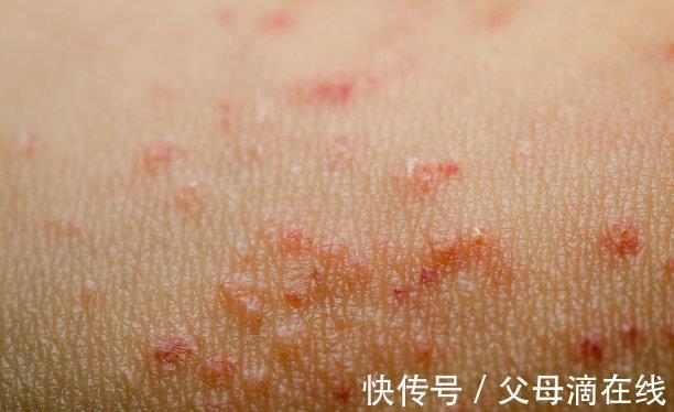 合理用药|湿疹缠身怎么办？这3个小诀窍，让你跟湿疹说拜拜