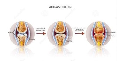 生活质量|预防骨关节炎怎么做?北京第一中西医结合医院白志强主任解答