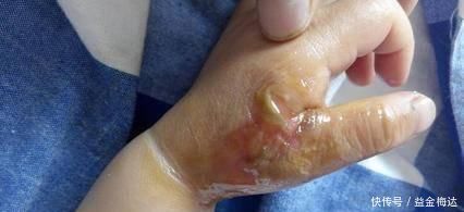 土方子|如果宝宝烫伤了宝妈们不要急，进来看看我教你！