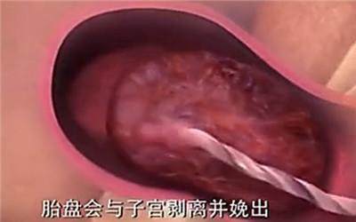 胎头那么大，到底是怎样从那么小的口出来顺产分娩全过程-附图