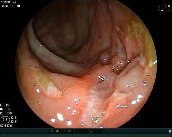 腹泻|从无锡治到上海，这个宝宝的“急性肠炎”不一般