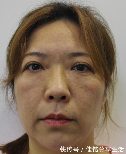 手术 52岁阿姨分享拉皮手术的真实心路历程!