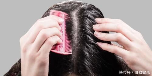 头皮发痒抠出的“白泥”是什么别以为是头皮屑,看看专家怎么说