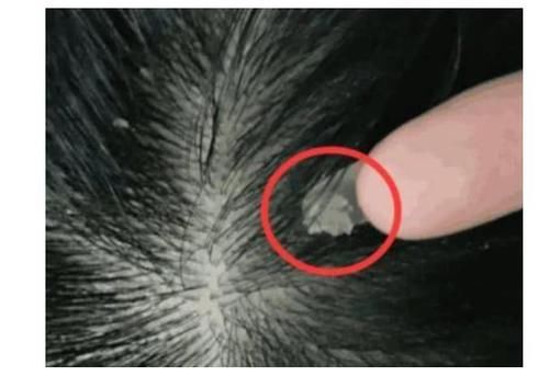  导致头皮|头皮上总能抠出白色的泥？还有痘痘和小硬块？医生告诉你答案！