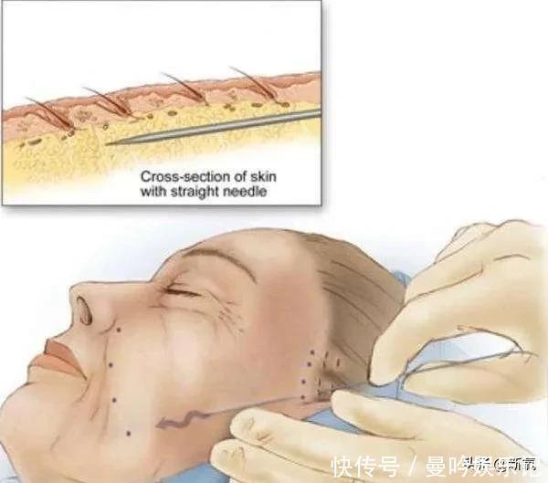 半个娱乐圈女明星脸上都有的这个坑,真的是线雕的锅吗?