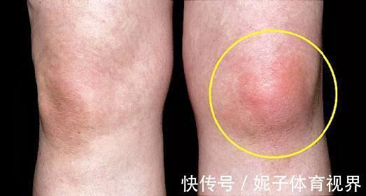 患者|膝盖疼,就是得滑膜炎了?医生辟谣,教您一步步判断自己的病因