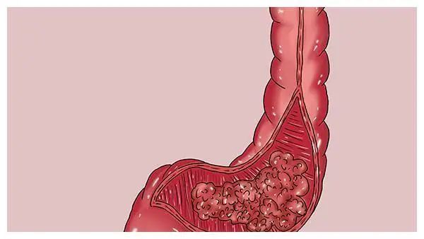 遗传性|这些人，更要进行结直肠癌筛查...甚至10岁就开始