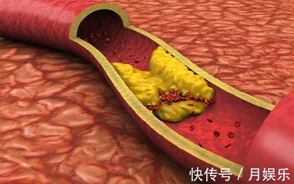 血脂异常|三甲院士降血脂不用那么麻烦，2个小方法，清理血管、血脂降了