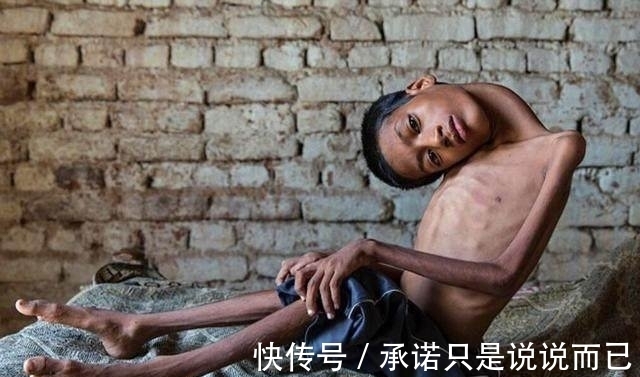 利瓦|男孩头部怪异,只能挂在胸前,手术7个月后的模样让人感动到哭!